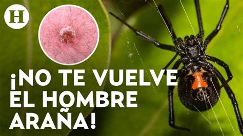 piroca negra|Picadura de la araña viuda negra: Instrucciones de cuidado.